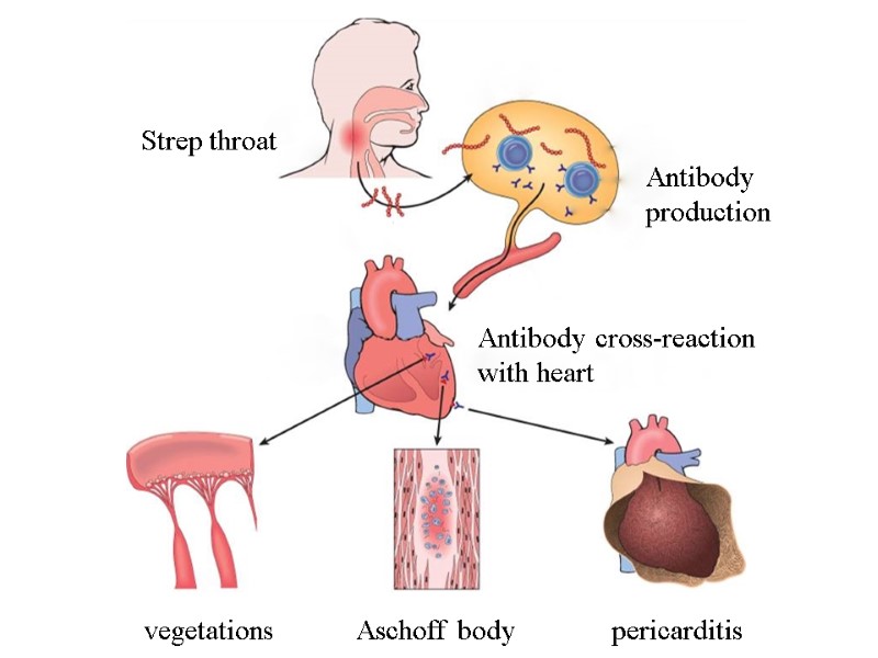 vegetations Aschoff body pericarditis Strep throat Antibody  production Antibody cross-reaction  with heart